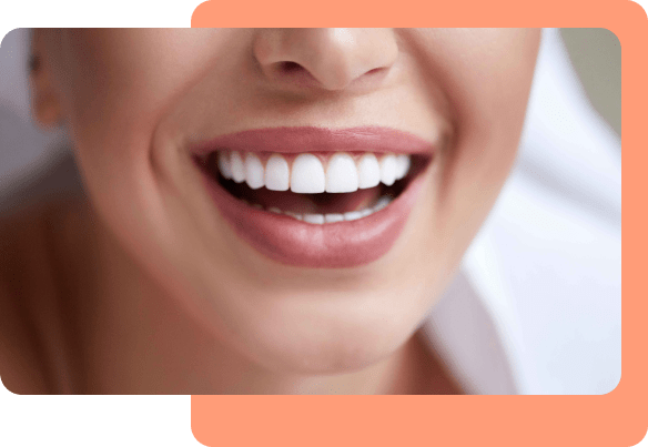 Dental-Veneer